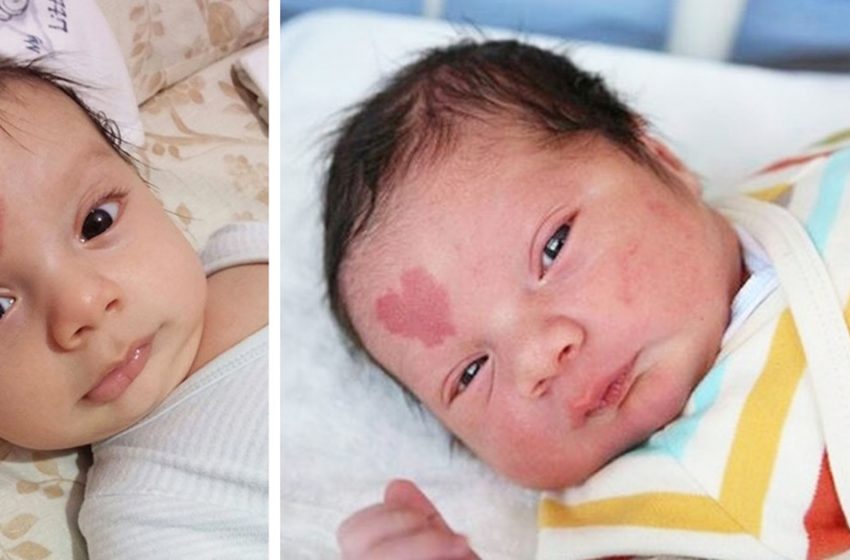  Как выглядит ребёнок, который родился с родимым пятном на лбу в виде сердечка?